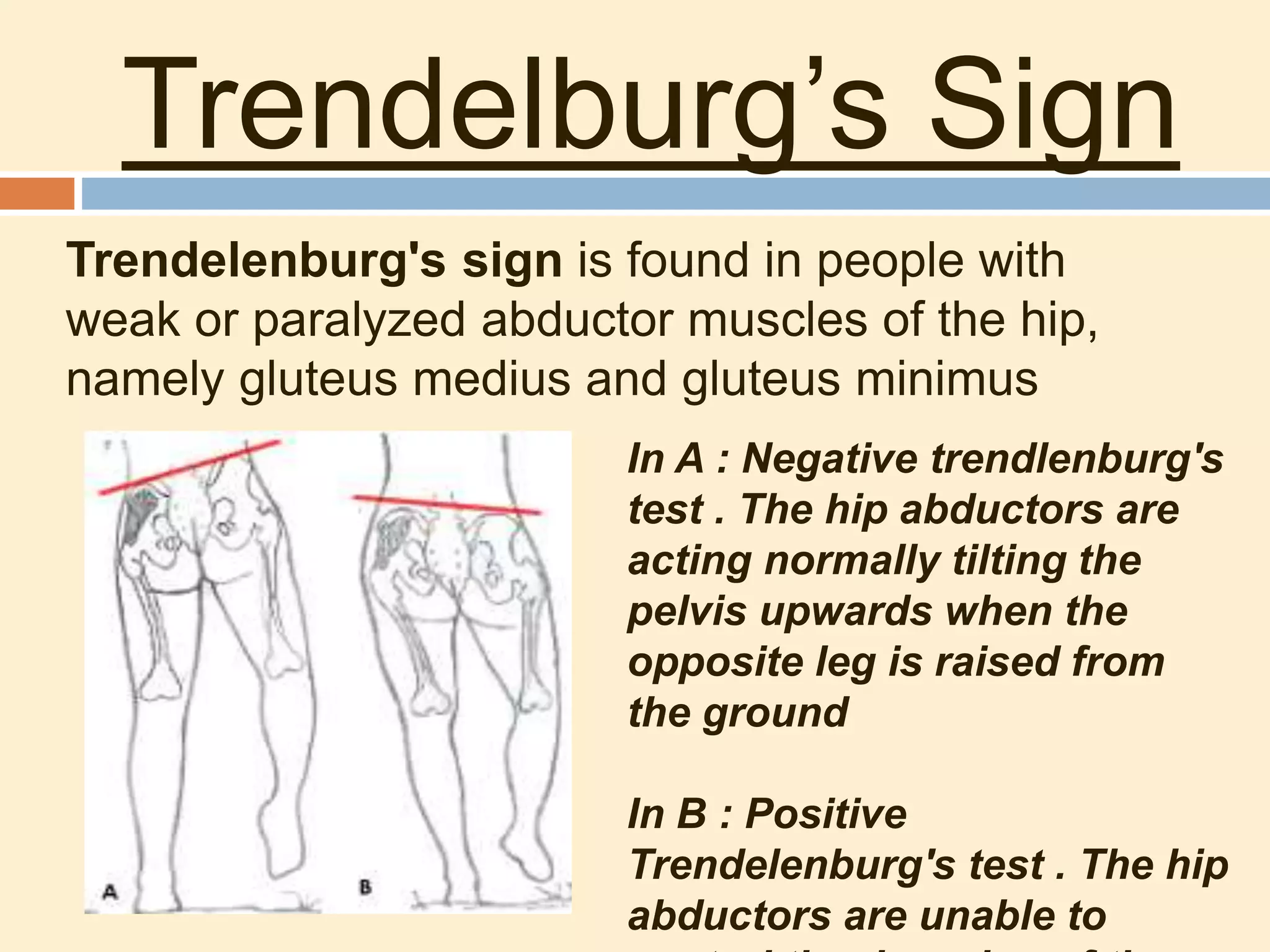 Trendelburg’s Sign
Trendelenburg's sign is found in people with
weak or paralyzed abductor muscles of the hip,
namely gluteus medius and gluteus minimus
In A : Negative trendlenburg's
test . The hip abductors are
acting normally tilting the
pelvis upwards when the
opposite leg is raised from
the ground
In B : Positive
Trendelenburg's test . The hip
abductors are unable to
 