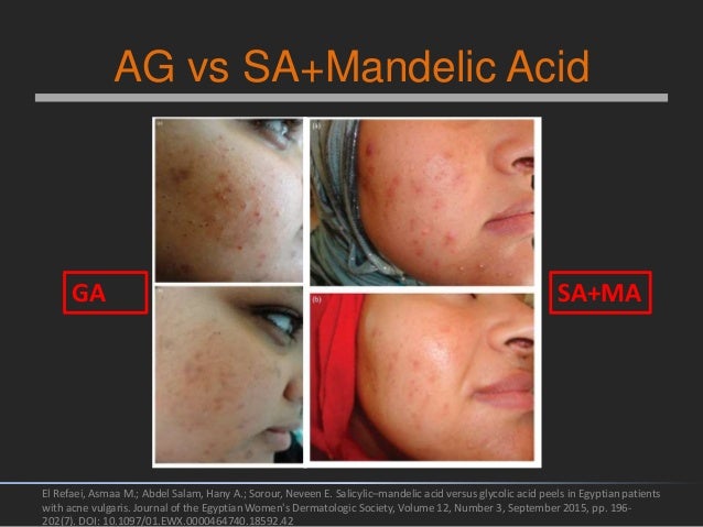 Glycolic acid peel for acne: is it still relevant? Glycolic acid peel for acne: is it still relevant?