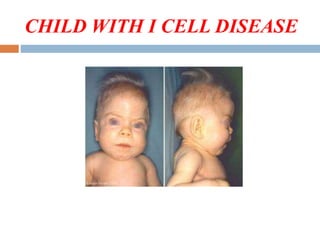 CHILD WITH I CELL DISEASE
 