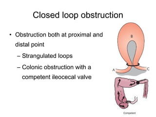 Closed loop obstruction
• Obstruction both at proximal and
distal point
– Strangulated loops
– Colonic obstruction with a
competent ileocecal valve
 