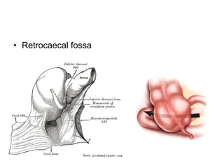 • Retrocaecal fossa
 