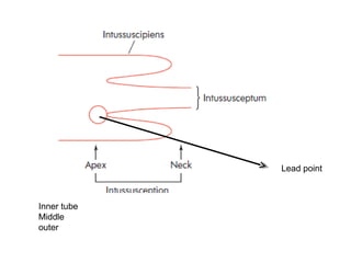 Lead point
Inner tube
Middle
outer
 