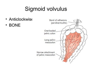 Sigmoid volvulus
• Anticlockwise
• BONE
 