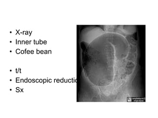 • X-ray
• Inner tube
• Cofee bean
• t/t
• Endoscopic reduction
• Sx
 