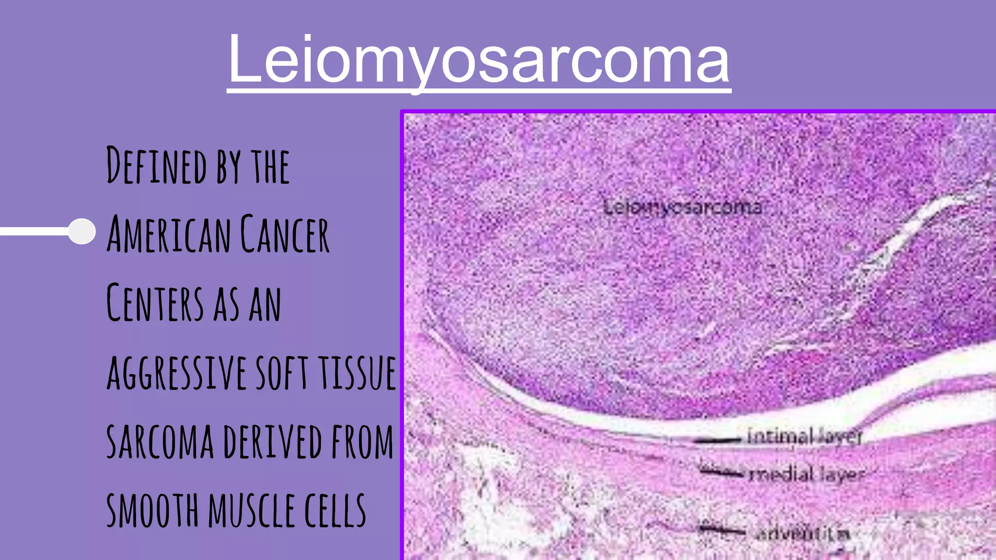 Leiomyosarcoma
Definedbythe
AmericanCancer
Centersasan
aggressivesofttissue
sarcomaderivedfrom
smoothmusclecells
