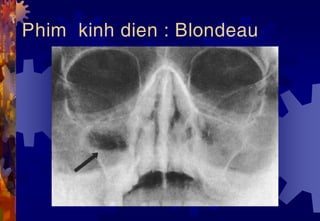 Phim kinh dien : Blondeau
 