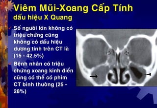 Vieâm Muõi-Xoang Caáp Tính
daáu hieäu X Quang
 Soá ngöôøi lôùn khoâng coù
trieäu chöùng cuõng
khoâng coù daáu hieäu
döông tính treân CT laø
(15 - 42.5%)
 Beänh nhaân coù trieäu
chöùng xoang kinh ñieån
cuõng coù theå coù phim
CT bình thöôøng (25 -
28%)
 