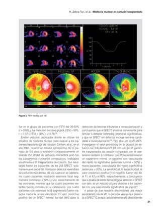H. Zetina Tun, et al.: Medicina nuclear en corazón trasplantado




Figura 2. FEVI medida por VIE.




fue en el grupo de pacientes con FEVI del 30-50%           detección de lesiones tributarias a revascularización y
(r = 0.89), y fue menor en los otros grupos (FEVI > 50%;   concluyeron que el SPECT anual es conveniente para
r = 0.72 y FEVI < 30%; r = 0.76)14.                        tamizar o detectar estenosis coronarias significativas,
   Existen estudios publicados donde se utilizan los       y que un SPECT sin defectos excluye lesiones candi-
estudios de medicina nuclear para evaluar a los pa-        datas a revascularización15. Yen, et al., en el año 2005,
cientes trasplantados de corazón. Carlsen, et al., en el   investigaron el valor pronóstico de la prueba de es-
año 2000, hicieron un estudio retrospectivo de un pe-      fuerzo con dobutamina-SPECT con talio en 47 pacien-
riodo de 5.6 años y evaluaron comparativamente un          tes trasplantados de corazón comparado con el cate-
total de 255 SPECT de perfusión miocárdica junto con       terismo cardíaco. Encontraron que 37 pacientes tuvieron
los cateterismos coronarios consecutivos, realizados       un cateterismo normal, un paciente tuvo vasculopatía
anualmente a 57 trasplantados de corazón. Sus resul-       del injerto no significativa (estenosis luminal < 50%) y
tados fueron los siguientes: de los 255 SPECT, sola-       nueve pacientes, vasculopatía del injerto significativa
mente nueve pacientes mostraron defectos reversibles       (estenosis > 50%). La sensibilidad, la especificidad, el
de perfusión miocárdica, de los cuales en el cateteris-    valor predictivo positivo y el negativo fueron del 89,
mo cuatro pacientes mostraron estenosis focal seg-         el 71, el 42 y el 96%, respectivamente, y concluyeron
mentaria coronaria (> 50%) y uno, estrechamiento de        que la prueba de estrés farmacológica, junto con el SPECT
las coronarias, mientras que los cuatro pacientes res-     con talio, es un método útil para detectar a los pacien-
tantes fueron normales en el cateterismo. Los cuatro       tes con una vasculopatía significativa del injerto16.
pacientes con estenosis focal segmentaria fueron tra-        A pesar de que nosotros encontramos una mayor
tados mediante revascularización. El valor predictivo      sensibilidad para la VIE, la principal ventaja que presen-
positivo de un SPECT normal fue del 98% para la            ta el SPECT-G es que, adicionalmente a la obtención de
                                                                                                                        31
 