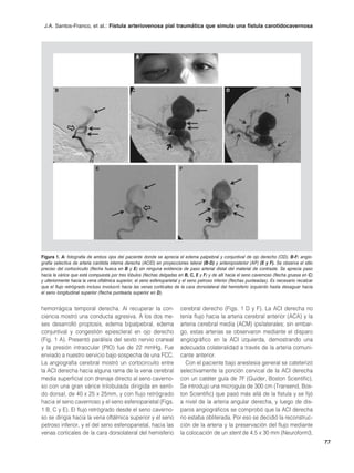 J.A. Santos-Franco, et al.: Fístula arteriovenosa pial traumática que simula una fístula carotidocavernosa




                                                   A




       B                                       C                                                D




                            E                                           F




Figura 1. A: fotografía de ambos ojos del paciente donde se aprecia el edema palpebral y conjuntival de ojo derecho (OD). B-F: angio-
grafía selectiva de arteria carótida interna derecha (ACID) en proyecciones lateral (B-D) y anteroposterior (AP) (E y F). Se observa el sitio
preciso del cortocircuito (flecha hueca en B y E) sin ninguna evidencia de paso arterial distal del material de contraste. Se aprecia paso
hacia la várice que está compuesta por tres lóbulos (flechas delgadas en B, C, E y F) y de allí hacia el seno cavernoso (flecha gruesa en C)
y ulteriormente hacia la vena oftálmica superior, el seno esfenoparietal y el seno petroso inferior (flechas punteadas). Es necesario recalcar
que el flujo retrógrado incluso involucró hacia las venas corticales de la cara dorsolateral del hemisferio izquierdo hasta desaguar hacia
el seno longitudinal superior (flecha punteada superior en D).


hemorrágica temporal derecha. Al recuperar la con-                      cerebral derecho (Figs. 1 D y F). La ACI derecha no
ciencia mostró una conducta agresiva. A los dos me-                     tenía flujo hacia la arteria cerebral anterior (ACA) y la
ses desarrolló proptosis, edema bipalpebral, edema                      arteria cerebral media (ACM) ipsilaterales; sin embar-
conjuntival y congestión epiescleral en ojo derecho                     go, estas arterias se observaron mediante el disparo
(Fig. 1 A). Presentó parálisis del sexto nervio craneal                 angiográfico en la ACI izquierda, demostrando una
y la presión intraocular (PIO) fue de 22 mmHg. Fue                      adecuada colateralidad a través de la arteria comuni-
enviado a nuestro servicio bajo sospecha de una FCC.                    cante anterior.
La angiografía cerebral mostró un cortocircuito entre                      Con el paciente bajo anestesia general se cateterizó
la ACI derecha hacia alguna rama de la vena cerebral                    selectivamente la porción cervical de la ACI derecha
media superficial con drenaje directo al seno caverno-                  con un catéter guía de 7F (Guider, Boston Scientific).
so con una gran várice trilobulada dirigida en senti-                   Se introdujo una microguía de 300 cm (Transend, Bos-
do dorsal, de 40 x 25 x 25mm, y con flujo retrógrado                    ton Scientific) que pasó más allá de la fístula y se fijó
hacia el seno cavernoso y el seno esfenoparietal (Figs.                 a nivel de la arteria angular derecha, y luego de dis-
1 B, C y E). El flujo retrógrado desde el seno caverno-                 paros angiográficos se comprobó que la ACI derecha
so se dirigía hacia la vena oftálmica superior y el seno                no estaba obliterada. Por eso se decidió la reconstruc-
petroso inferior, y el del seno esfenoparietal, hacia las               ción de la arteria y la preservación del flujo mediante
venas corticales de la cara dorsolateral del hemisferio                 la colocación de un stent de 4.5 x 30 mm (Neuroform3,
                                                                                                                                                 77
 