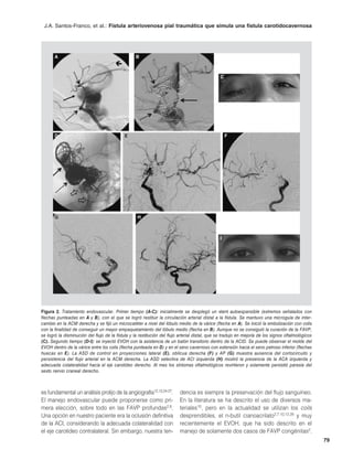 J.A. Santos-Franco, et al.: Fístula arteriovenosa pial traumática que simula una fístula carotidocavernosa




       A                                          B



                                                                                                C




       D                                    E                                                       F




       G                                           H



                                                                                                I




Figura 2. Tratamiento endovascular. Primer tiempo (A-C): inicialmente se desplegó un stent autoexpansible (extremos señalados con
flechas punteadas en A y B), con el que se logró restituir la circulación arterial distal a la fístula. Se mantuvo una microguía de inter-
cambio en la ACM derecha y se fijó un microcatéter a nivel del lóbulo medio de la várice (flecha en A). Se inició la embolización con coils
con la finalidad de conseguir un mayor empaquetamiento del lóbulo medio (flecha en B). Aunque no se consiguió la curación de la FAVP,
se logró la disminución del flujo de la fístula y la restitución del flujo arterial distal, que se tradujo en mejoría de los signos oftalmológicos
(C). Segundo tiempo (D-I): se inyectó EVOH con la asistencia de un balón transitorio dentro de la ACID. Se puede observar el molde del
EVOH dentro de la várice entre los coils (flecha punteada en D) y en el seno cavernoso con extensión hacia el seno petroso inferior (flechas
huecas en E). La ASD de control en proyecciones lateral (E), oblicua derecha (F) y AP (G) muestra ausencia del cortocircuito y
persistencia del flujo arterial en la ACM derecha. La ASD selectiva de ACI izquierda (H) mostró la presencia de la ACA izquierda y
adecuada colateralidad hacia el eje carotídeo derecho. Al mes los síntomas oftalmológicos revirtieron y solamente persistió paresia del
sexto nervio craneal derecho.



es fundamental un análisis prolijo de la angiografía12,13,24-27.          dencia es siempre la preservación del flujo sanguíneo.
El manejo endovascular puede proponerse como pri-                         En la literatura se ha descrito el uso de diversos ma-
mera elección, sobre todo en las FAVP profundas2,8.                       teriales10, pero en la actualidad se utilizan los coils
Una opción en nuestro paciente era la oclusión definitiva                 desprendibles, el n-butil cianoacrilato2,7,10,12,28 y muy
de la ACI, considerando la adecuada colateralidad con                     recientemente el EVOH, que ha sido descrito en el
el eje carotídeo contralateral. Sin embargo, nuestra ten-                 manejo de solamente dos casos de FAVP congénitas2.
                                                                                                                                                     79
 