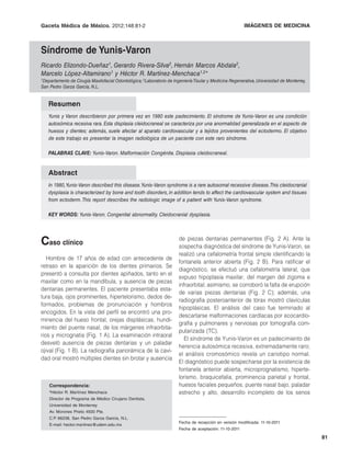 Gaceta Médica de México. 2012;148:81-2                                R. Elizondo-Dueñaz, et al.: IMÁGENESde Yunis-Varon
                                                                                                   Síndrome DE MEDICINA



Síndrome de Yunis-Varon
Ricardo Elizondo-Dueñaz1, Gerardo Rivera-Silva2, Hernán Marcos Abdala2,
Marcelo López-Altamirano1 y Héctor R. Martínez-Menchaca1,2*
1Departamentode Cirugía Maxilofacial Odontológica; 2Laboratorio de Ingeniería Tisular y Medicina Regenerativa, Universidad de Monterrey,
San Pedro Garza García, N.L.


   Resumen
   Yunis y Varon describieron por primera vez en 1980 este padecimiento. El síndrome de Yunis-Varon es una condición
   autosómica recesiva rara. Esta displasia cleidocraneal se caracteriza por una anormalidad generalizada en el aspecto de
   huesos y dientes; además, suele afectar al aparato cardiovascular y a tejidos provenientes del ectodermo. El objetivo
   de este trabajo es presentar la imagen radiológica de un paciente con este raro síndrome.

   PALABRAS CLAVE: Yunis-Varon. Malformación Congénita. Displasia cleidocraneal.


   Abstract
   In 1980, Yunis-Varon described this disease. Yunis-Varon syndrome is a rare autosomal recessive disease. This cleidocranial
   dysplasia is characterized by bone and tooth disorders, in addition tends to affect the cardiovascular system and tissues
   from ectoderm. This report describes the radiologic image of a patient with Yunis-Varon syndrome.

   KEY WORDS: Yunis-Varon. Congenital abnormality. Cleidocranial dysplasia.




Caso clínico                                                          de piezas dentarias permanentes (Fig. 2 A). Ante la
                                                                      sospecha diagnóstica del síndrome de Yunis-Varon, se
                                                                      realizó una cefalometría frontal simple identificando la
   Hombre de 17 años de edad con antecedente de
                                                                      fontanela anterior abierta (Fig. 2 B). Para ratificar el
retraso en la aparición de los dientes primarios. Se
                                                                      diagnóstico, se efectuó una cefalometría lateral, que
presentó a consulta por dientes apiñados, tanto en el
                                                                      expuso hipoplasia maxilar, del margen del zigoma e
maxilar como en la mandíbula, y ausencia de piezas
                                                                      infraorbital; asimismo, se corroboró la falta de erupción
dentarias permanentes. El paciente presentaba esta-
                                                                      de varias piezas dentarias (Fig. 2 C); además, una
tura baja, ojos prominentes, hipertelorismo, dedos de-
                                                                      radiografía posteroanterior de tórax mostró clavículas
formados, problemas de pronunciación y hombros
                                                                      hipoplásicas. El análisis del caso fue terminado al
encogidos. En la vista del perfil se encontró una pro-
                                                                      descartarse malformaciones cardíacas por ecocardio-
minencia del hueso frontal, orejas displásicas, hundi-
                                                                      grafía y pulmonares y nerviosas por tomografía com-
miento del puente nasal, de los márgenes infraorbita-
                                                                      putarizada (TC).
rios y micrognatia (Fig. 1 A). La examinación intraoral
                                                                         El síndrome de Yunis-Varon es un padecimiento de
desveló ausencia de piezas dentarias y un paladar
                                                                      herencia autosómica recesiva, extremadamente raro;
ojival (Fig. 1 B). La radiografía panorámica de la cavi-
                                                                      el análisis cromosómico revela un cariotipo normal.
dad oral mostró múltiples dientes sin brotar y ausencia
                                                                      El diagnóstico puede sospecharse por la existencia de
                                                                      fontanela anterior abierta, microprognatismo, hiperte-
                                                                      lorismo, braquicefalia, prominencia parietal y frontal,
    Correspondencia:                                                  huesos faciales pequeños, puente nasal bajo, paladar
    *Héctor R. Martínez Menchaca                                      estrecho y alto, desarrollo incompleto de los senos
    Director de Programa de Médico Cirujano Dentista,
    Universidad de Monterrey
    Av. Morones Prieto 4500 Pte.
    C.P. 66238, San Pedro Garza García, N.L.
                                                                      Fecha de recepción en versión modificada: 11-10-2011
    E-mail: hector.martinez@udem.edu.mx
                                                                      Fecha de aceptación: 11-10-2011

                                                                                                                                           81
 