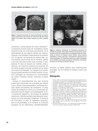 Gaceta Médica de México. 2012;148




            A                      B                                                A




                                                                                    B                        C


     Figura 1. Imágenes del paciente. A: vista de perfil donde se muestran
     rasgos característicos del síndrome de Yunis-Varon. B: vista oclusal
     superior que expone varias piezas dentarias sin brotar y paladar
     ojival.




     accesorios y células aéreas del hueso mastoideo1,2.
     La dentición primaria suele ser incompleta y tardía,
                                                                             Figura 2. Imágenes radiológicas. A: Radiografía panorámica de
     situación similar con la dentición permanente, con la                   cavidad oral muestra varias piezas dentarias sin erupcionar (seudo-
     particularidad de que algunos dientes son supernu-                      anodoncia). B: Vista posteroanterior de radiografía simple de cráneo,
     merarios y mal alineados, especialmente los premola-                    donde se observa la fontanela anterior abierta, huesos faciales
                                                                             hipoplásicos, puente nasal bajo y neumatización adecuada de los
     res3. En general, son personas de estatura baja, con                    senos paranasales. C: Cefalometría lateral que exhibe la hipoplasia
     una posición anormal baja de los hombros, debido                        de la mandíbula, del margen del zigoma e infraorbital y del maxilar,
     a que las clavículas pueden estar ausentes o hipo-                      asimismo se corrobora la retención dentaria.
     plásicas. El tórax es angosto por costillas cortas y
     oblicuas, con presencia ocasional de escoliosis. En
     las manos pueden presentar asimetría de los dedos                       asimismo, se deben detectar otras malformaciones
     por ausencia de falanges4. Su inteligencia es normal,                   asociadas, con la finalidad de tratarlas cuando sea
     aunque puede asociarse con déficit auditivo. El exa-                    factible8.
     men radiológico se caracteriza por anormalidades
     de cráneo, maxilares, dientes, clavículas y huesos                      Bibliografía
     largos5.                                                                  1. Yunis E, Varon H. Cleidocranial dysostosis severe micrognathism bilat-
        Aunque es extremadamente raro, este síndrome                              eral absence of thumbs and first metatarsal bone and distal aphalangia:
                                                                                  A new genetic syndrome. Am J Dis Child. 1980;134:649-53.
     puede estar relacionado con anomalías que afectan                         2. Hughes HE, Partingtong MW. Brief clinical report: the syndrome of Yunis
     a ojos, sistema musculoesquelético, cardiovascular y                         and Varon - report of a further case. Am J Med Genet. 1983;14:539-44.
                                                                               3. Jensen BL, Kreiborg S. Development of the dentition in cleidocranial
     otros tejidos provenientes del ectodermo6. El diag-                          dysplasia. J Oral Path Med. 1990;19:89-93.
                                                                               4. Richardson A, Deussen FF. Facial and dental anomalies in cleidocra-
     nóstico de sospecha es clínico y es corroborado me-                          nial dysplasia: a study of 17 cases. Int J Pediatr Dent. 1994;4:225-31.
     diante técnicas de imagen. La ecocardiografía, la TC,                     5. Lapeer GL, Fransman SL. Hypodontia, impacted pemanent teeth, spinal
                                                                                  defects, and cardiomegaly in a previously diagnosed case of the Yunis-
     la resonancia magnética y las pruebas de agudeza                             Varon syndrome. Oral Surg, Oral Med, Oral Pathol. 1992;73:456-60.
                                                                               6. Corona JR, Romo CO, López E, Ramos F, Estrada S, Zepeda L. New
     auditiva son métodos auxiliares para descartar la aso-                       ocular findings in two sisters with Yunis-Varon syndrome and literature
     ciación con otras anomalías congénitas7. El síndrome                         review. Eur J Med Gen. 2011;54:76-81.
                                                                               7. Ba KD, Diagne F, Diop F, Sarr MM. Prévalence des inclusions et réten-
     de Yunis-Varon no tiene un tratamiento específico,                           tions dentaires dans una population noire sénégalaise. Inter Orthod.
     pero es recomendable, si es meritoria, la corrección                         2007;5:425-36.
                                                                               8. Dworzak F, Mora M, Borroni C, et al. Generalized lysosoomal storage in
     quirúrgica de las alteraciones craneofaciodentales;                          Yunis-varon syndrome. Neuromusc Disord. 1995;5:423-8.




82
 