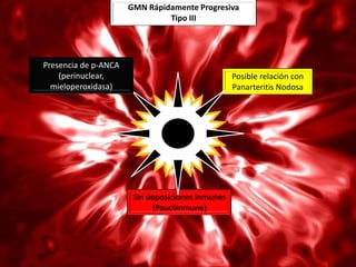 GMN Rápidamente Progresiva
                               Tipo III




Presencia de p-ANCA
    (perinuclear,                                 Posible relación con
  mieloperoxidasa)                                Panarteritis Nodosa




                       Sin deposiciones inmunes
                            (Paucilinmune)
 