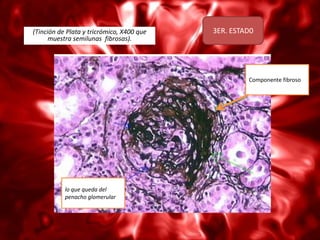 (Tinción de Plata y tricrómico, X400 que   3ER. ESTAD0
      muestra semilunas fibrosas).




                                                    Componente fibroso




           lo que queda del
           penacho glomerular
 