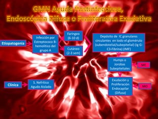 Faríngeo
                   Infección por    (6-10 d)        Depósito de IC granulares
                  Estreptococo B-               circulantes en todo el glomérulo
Etiopatogenia                                   (subendotelial/subepitelial) (Ig G-
                   hemolítico del
                      grupo A        Cutáneo            C3-Fibrina) (IMF)
                                    (2-3 sem)
                                                            Humps o
                                                             Jorobas              ME
                                                          Subepiteliales


                                                            Exudación y
                 S. Nefrítico
   Clínica                                                  Proliferación
                Agudo Aislado                                                     MO
                                                            Endocapilar
                                                              (Difusa)
 