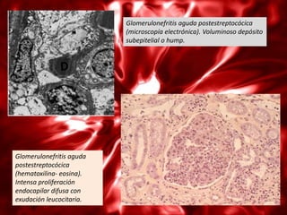 Glomerulonefritis aguda postestreptocócica
                          (microscopía electrónica). Voluminoso depósito
                          subepitelial o hump.




Glomerulonefritis aguda
postestreptocócica
(hematoxilina- eosina).
Intensa proliferación
endocapilar difusa con
exudación leucocitaria.
 