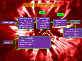 ME
                                                                  MO

                Formación in situ        Engrosamiento
                de complejos Ag-         de pared capilar   Engrosamiento
Etiopatogenia                                                 de MB por          S. Nefrótico
                  Ac granulares           y spikes de MB
                subepiteliales de            a espacio      lesión y spikes
                MB (Ig G-C3) (IMF)            urinario
                                                                         Proteinuria >3g/24h +
                                                                          Hipoalbuminemia +
                                                                         Dislipemia + Edema +
                                                                           Hipercoagubilidad
                 Tumores Sólidos
                 Infecciones Crónicas
  Causas         Enf. Reumáticas
                 Metales Pesados
                 Otras
 