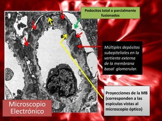 Podocitos total o parcialmente
                       fusionados




                         Múltiples depósitos
                         subepiteliales en la
                         vertiente externa
                         de la membrana
                         basal glomerular.




                          Proyecciones de la MB
                          (corresponden a las
Microscopio               espículas vistas al
                          microscopio óptico)
Electrónico
 