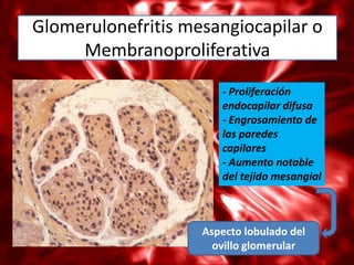 Glomerulonefritis mesangiocapilar o
     Membranoproliferativa
                       - Proliferación
                       endocapilar difusa
                       - Engrosamiento de
                       las paredes
                       capilares
                       - Aumento notable
                       del tejido mesangial



                    Aspecto lobulado del
                      ovillo glomerular
 