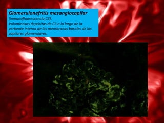 Glomerulonefritis mesangiocapilar
(inmunofluorescencia,C3).
Voluminosos depósitos de C3 a lo largo de la
vertiente interna de las membranas basales de los
capilares glomerulares.
 