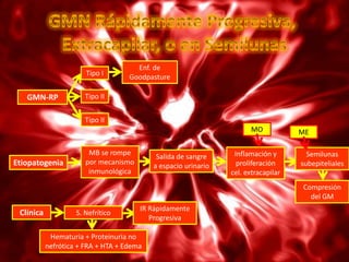 Enf. de
                       Tipo I       Goodpasture

   GMN-RP              Tipo II


                       Tipo II
                                                                      MO            ME

                        MB se rompe                              Inflamación y        Semilunas
                                            Salida de sangre
Etiopatogenia          por mecanismo                              proliferación     subepiteliales
                                           a espacio urinario
                        inmunológica                            cel. extracapilar
                                                                                    Compresión
                                                                                      del GM
                                       IR Rápidamente
 Clínica            S. Nefrítico
                                          Progresiva

            Hematuria + Proteinuria no
           nefrótica + FRA + HTA + Edema
 