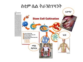 ስቲም ሴል ትራንስፕላንት
f ሊኩሚያ
ነርቭ
መስል
ዳይትሮፊ
 