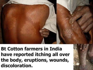 Bt Cotton farmers in India have reported itching all over the body, eruptions, wounds, discoloration.