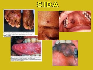 SIDA 