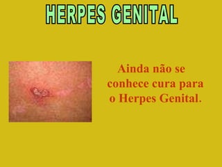 HERPES GENITAL Ainda não se conhece cura para o Herpes Genital. 