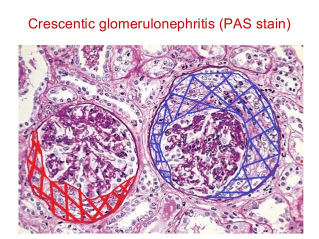 Glomerulonephritis Natural Treatment Glomerulonephritis Natural Treatment