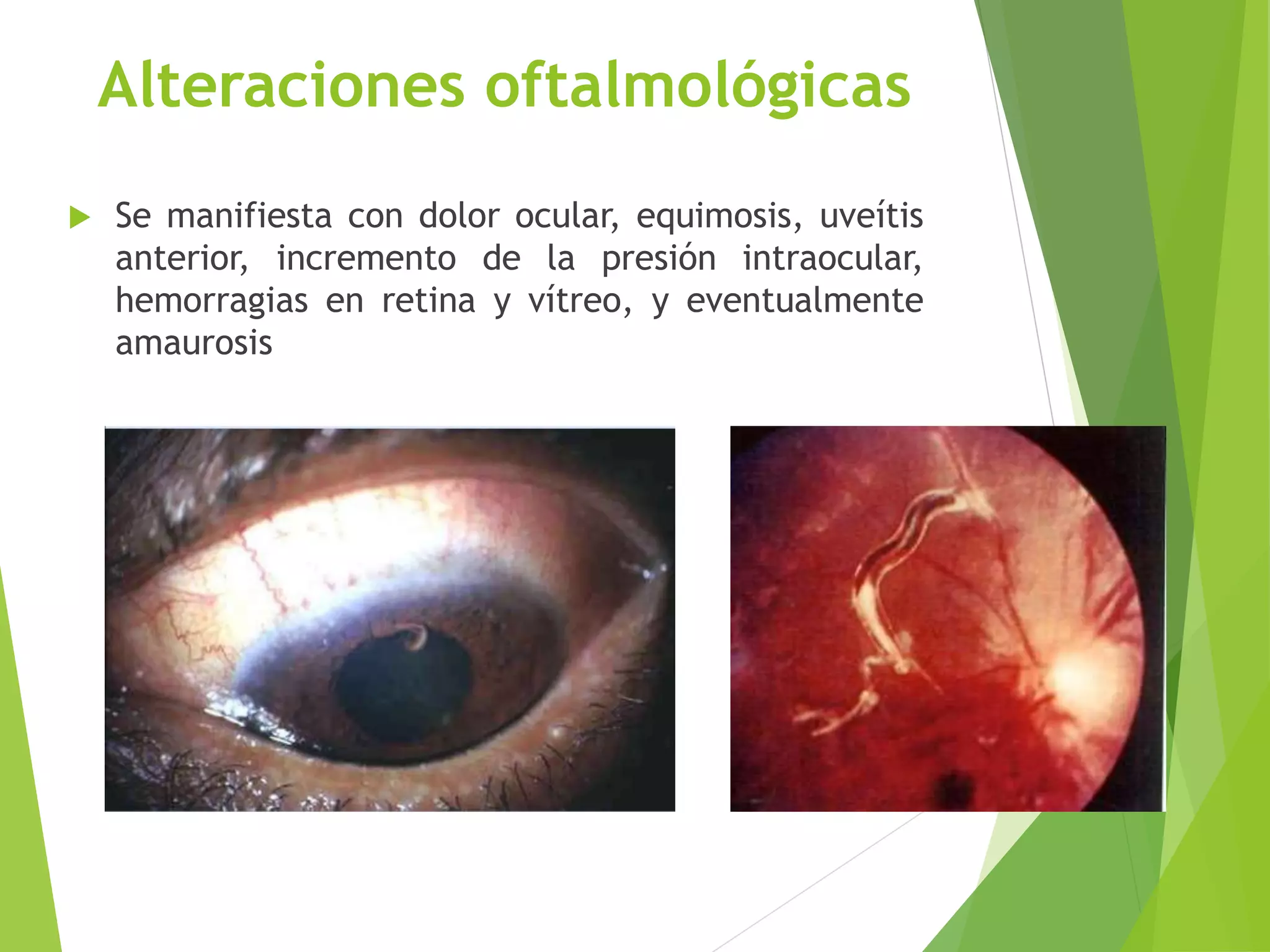 Alteraciones oftalmológicas
 Se manifiesta con dolor ocular, equimosis, uveítis
anterior, incremento de la presión intraocular,
hemorragias en retina y vítreo, y eventualmente
amaurosis
 