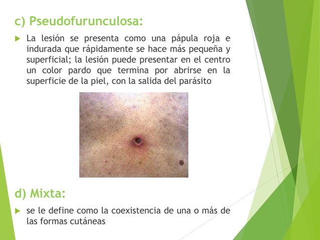 Gnatostomiasis
