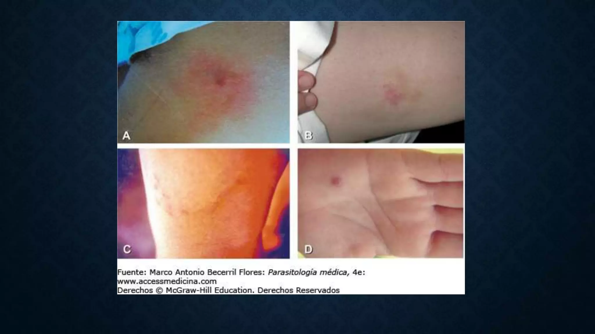 Gnatostomiasis PPT
