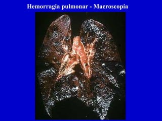 Hemorragia pulmonar - Macroscopía
 