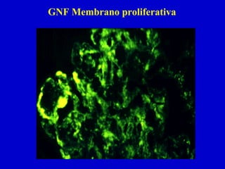 GNF Membrano proliferativa
 