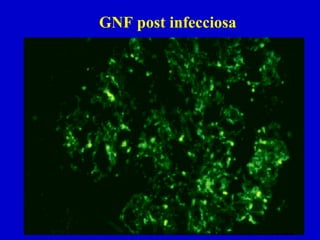 GNF post infecciosa
 