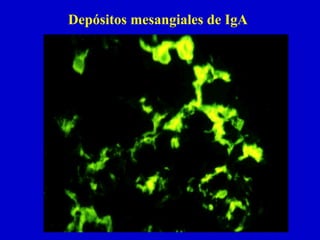 Depósitos mesangiales de IgA
 