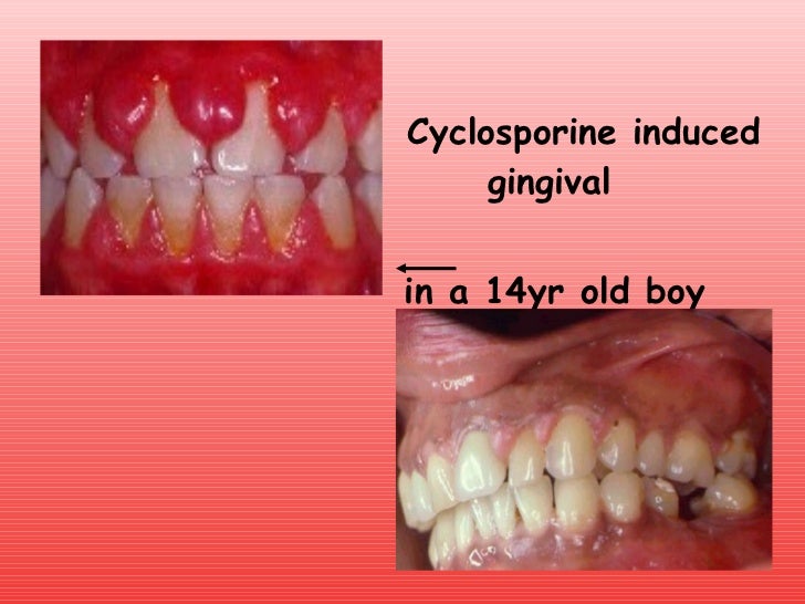 gngival enlargement gingival hyperplasia