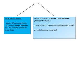 Faible grossissement:
- lésions diffuses et globales
- glomérules hypercellulaires
avec des lumières capillaires
peu visibles.
Fort grossissement: 4 lésions caractéristiques
(globales et diffuses) :
Une prolifération mésangiale (et/ou endocapillaire)
Un épaississement mésangial
 