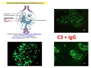 -Prédominance de dépôts granuleux sous-endothéliaux
(Dépôts inconstants mésangiaux et
-extra-membraneux (de type « humps »))
C3 + IgG
 