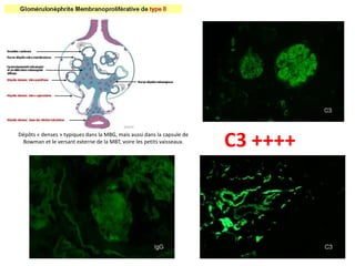Dépôts « denses » typiques dans la MBG, mais aussi dans la capsule de
Bowman et le versant externe de la MBT, voire les petits vaisseaux.
C3 ++++
 
