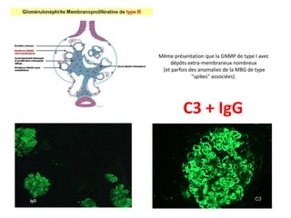 Même présentation que la GNMP de type I avec
dépôts extra-membraneux nombreux
(et parfois des anomalies de la MBG de type
"spikes" associées).
C3 + IgG
 