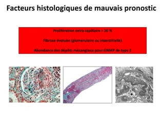 Facteurs histologiques de mauvais pronostic
Prolifération extra capillaire > 20 %
Fibrose évoluée (glomérulaire ou interstitielle)
Abondance des dépôts mésangiaux pour GNMP de type 2
 