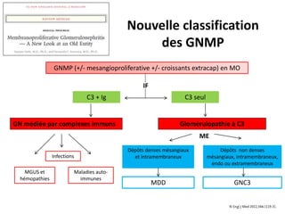 Nouvelle classification
des GNMP
GNMP (+/- mesangioproliferative +/- croissants extracap) en MO
IF
C3 + Ig C3 seul
GN médiée par complexes immuns Glomérulopathie à C3
Infections
Maladies auto-
immunes
MGUS et
hémopathies
Dépôts denses mésangiaux
et intramembraneux
Dépôts non denses
mésangiaux, intramembraneux,
endo ou extramembraneux
MDD GNC3
ME
 