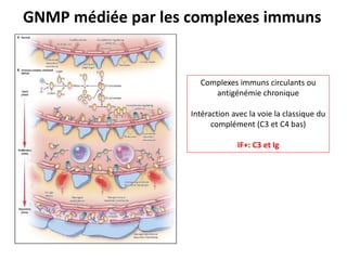 GNMP médiée par les complexes immuns
Complexes immuns circulants ou
antigénémie chronique
Intéraction avec la voie la classique du
complément (C3 et C4 bas)
IF+: C3 et Ig
 