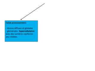 Faible grossissement:
- lésions diffuses et globales
- glomérules hypercellulaires
avec des lumières capillaires
peu visibles.
 