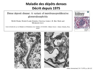 Maladie des dépôts denses
Décrit depuis 1975
 