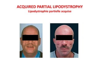 ACQUIRED PARTIAL LIPODYSTROPHY
Lipodystrophie partielle acquise
 