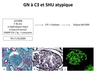 12/1998
F 36 ans
S néphrotique impur
C3 bas C4 normal
GNMP C3+ / Ig - + croissants
CTC + Endoxan Dialyse 04/1999
GN à C3 et SHU atypique
TR n°1 01/2004
 