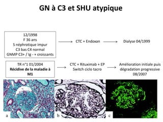 12/1998
F 36 ans
S néphrotique impur
C3 bas C4 normal
GNMP C3+ / Ig - + croissants
CTC + Endoxan Dialyse 04/1999
GN à C3 et SHU atypique
TR n°1 01/2004
Récidive de la maladie à
M1
CTC + Rituximab + EP
Switch ciclo tacro
Amélioration initiale puis
dégradation progressive
08/2007
 